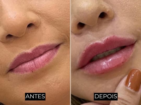 Antes e depois de harmonização facial - caso 1
