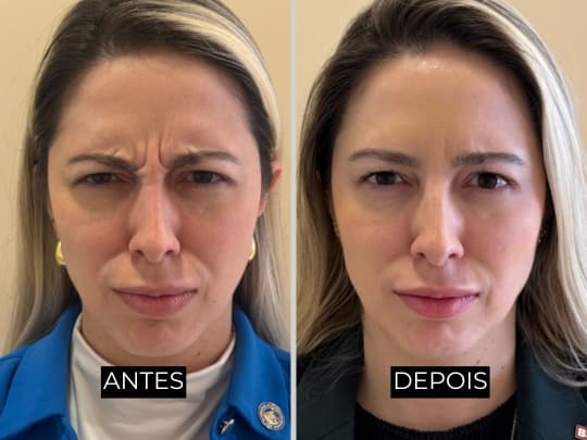 Antes e depois de harmonização facial - caso 3