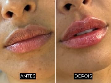 Antes e depois de harmonização facial - caso 6