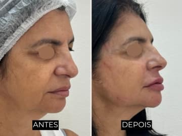 Antes e depois de harmonização facial - caso 7