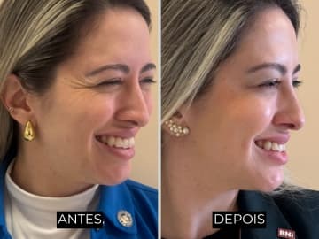 Antes e depois de harmonização facial - caso 8
